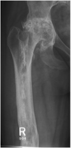 Femoral Osteomyelitis